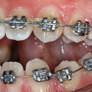 Orthodontic Archwires: Latest Advances in Orthodontic Technology