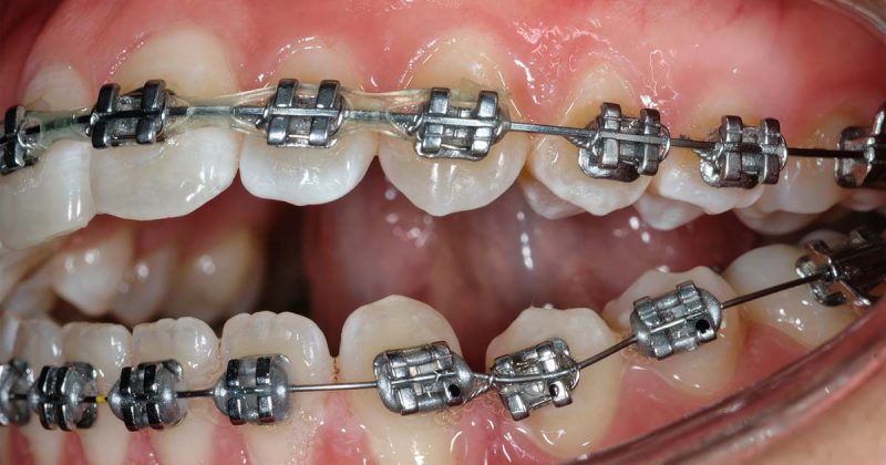 Orthodontic Archwires: Latest Advances in Orthodontic Technology