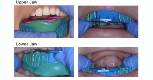 alginate impression 