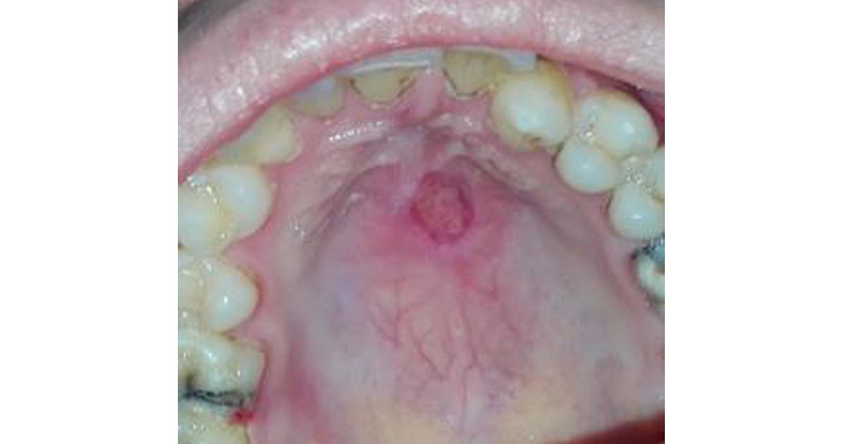 Postanesthetic Intraoral Lesions