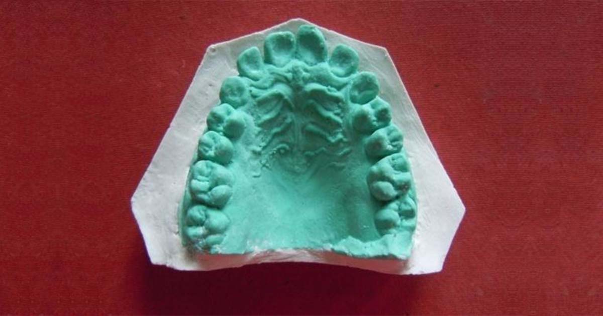 Traditional Plaster Casts