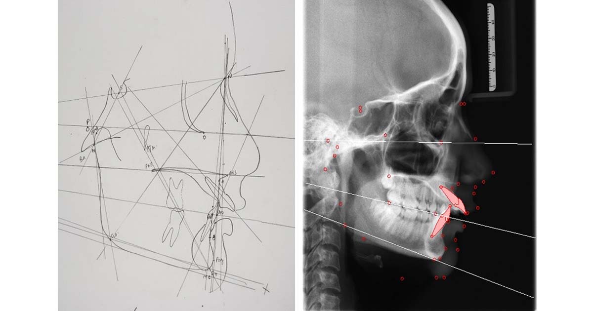 Cephalometric tracing by hand