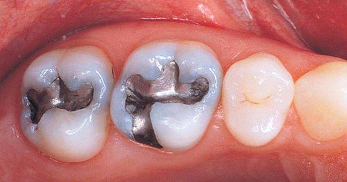 Amalgam restorations