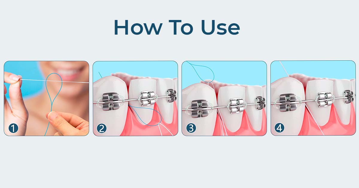 Floss Threader or Super Floss