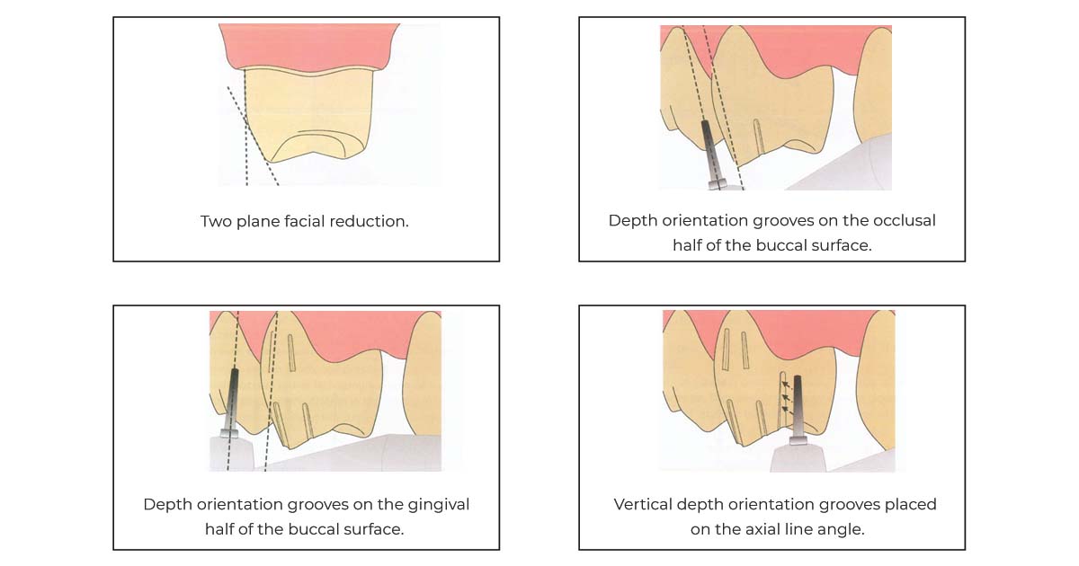 posterior metal ceram tooth prep