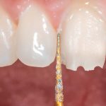 Tooth Preparation