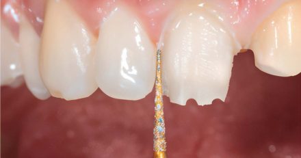 Tooth Preparation: A Student’s Guide for Full Coverage Dental Crown
