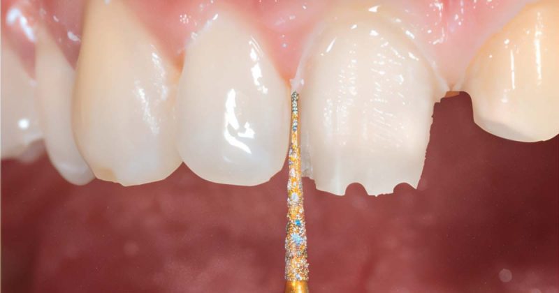 Tooth Preparation: A Student’s Guide for Full Coverage Dental Crown Tooth Preparation: A Student’s Guide for Full Coverage Dental Crown