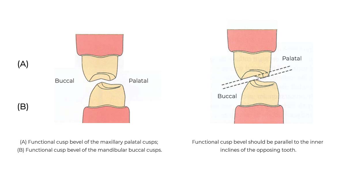 posterior metal ceram tooth preparation