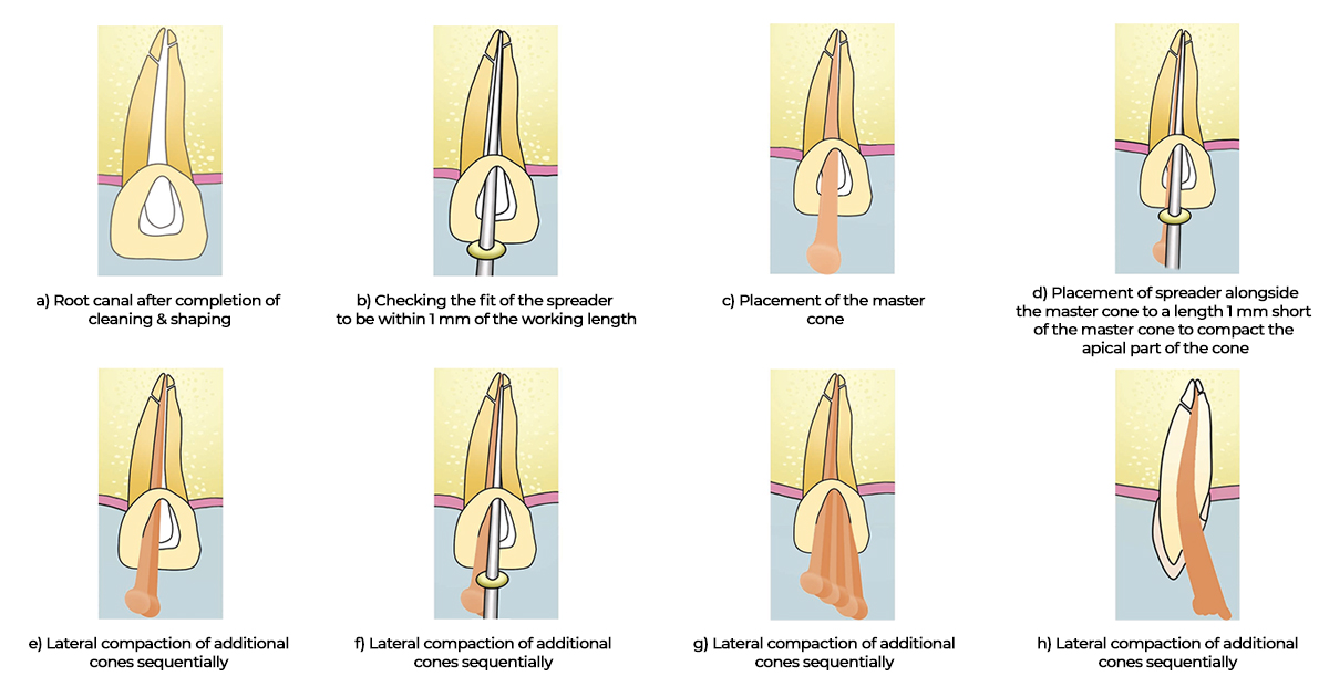 Cold Lateral Compaction