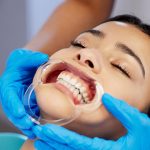 Cheek Retractors