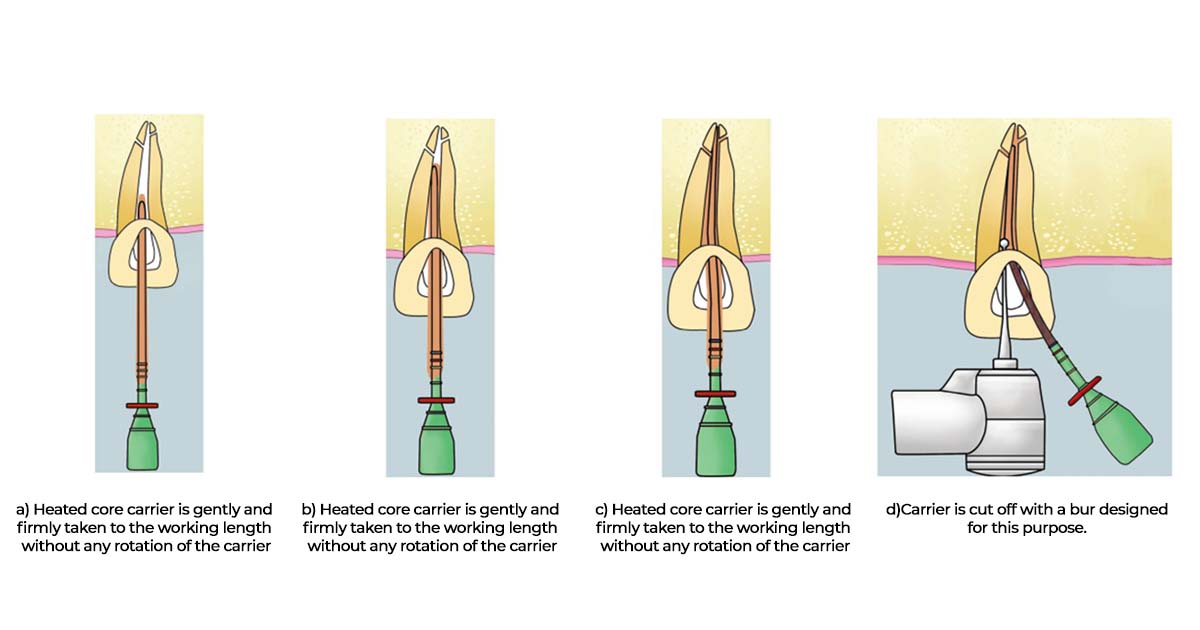 Thermafil technique