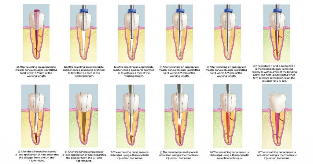 continuous wave compaction