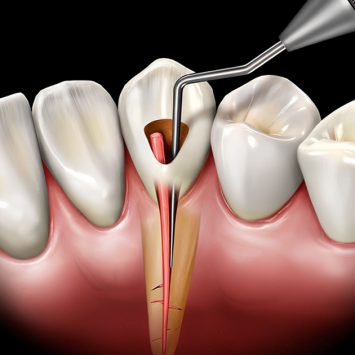 Effective Obturation Techniques for Successful Root Canal Treatments