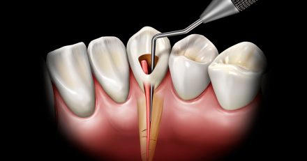 Effective Obturation Techniques for Successful Root Canal Treatments