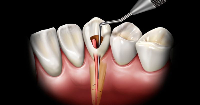 Effective Obturation Techniques for Successful Root Canal Treatments