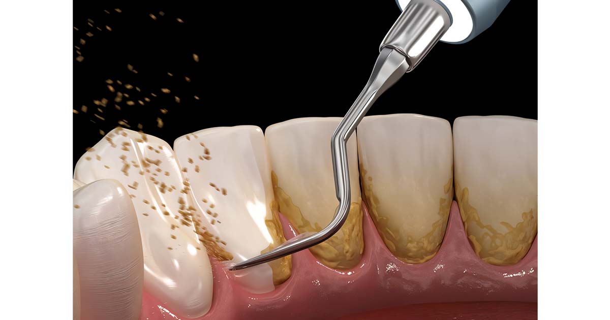 tooth scaling