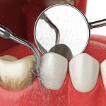 Tooth Scaling Truths