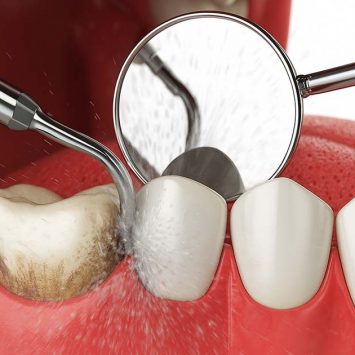 Tooth Scaling Truths Every Dentist Should Share with Patients