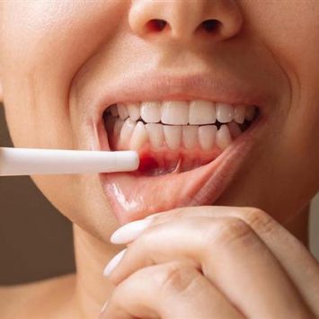 What Is Mouth Ulcer Gel and How Is It Used? – A Dentist’s Guide 