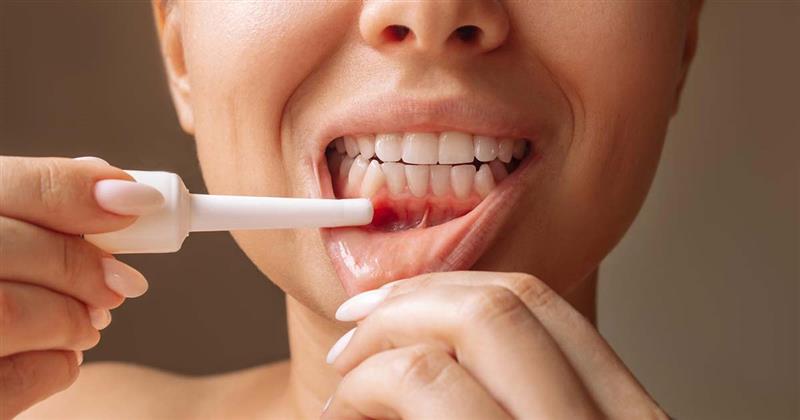 What Is Mouth Ulcer Gel and How Is It Used? – A Dentist’s Guide What Is Mouth Ulcer Gel and How Is It Used? – A Dentist’s Guide