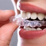 In-house clear aligner setup