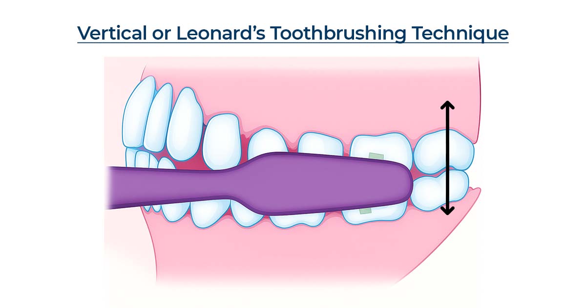 Vertical or Leonard’s Technique
