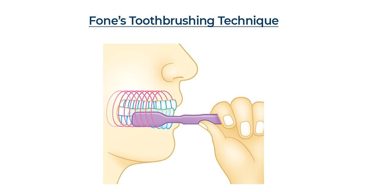 Fone’sTechnique