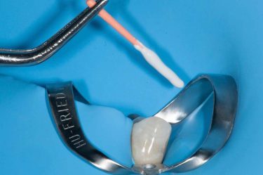 Emerging Bioceramic Materials in Endodontics