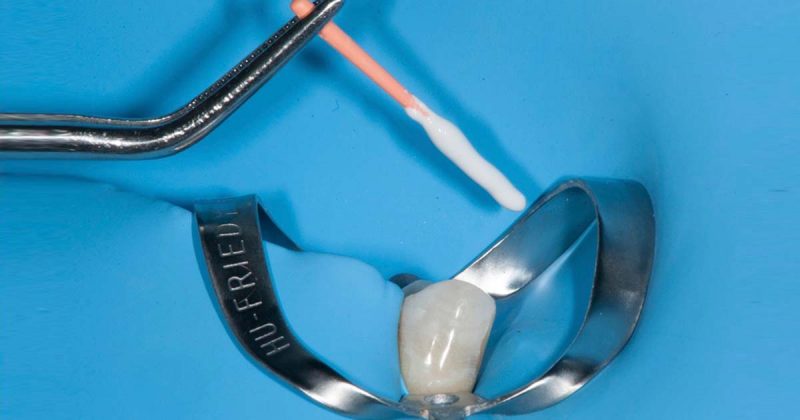 Emerging Bioceramic Materials in Endodontics: Benefits, Limitations, and Clinical Applications Emerging Bioceramic Materials in Endodontics: Benefits, Limitations, and Clinical Applications