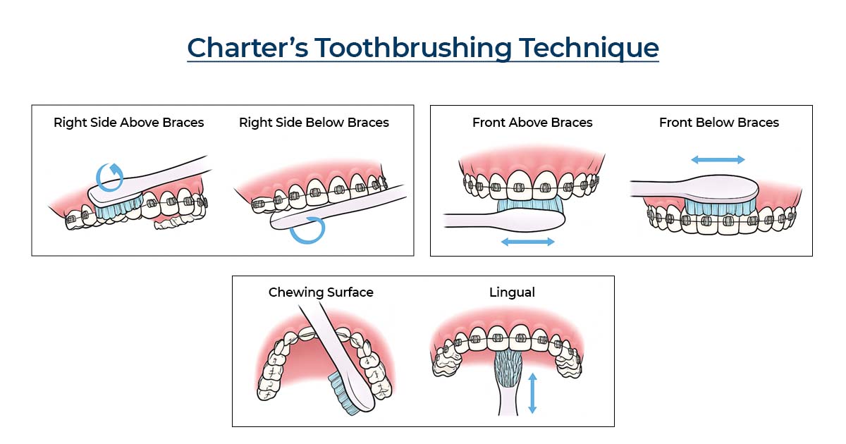 Charter’s Technique