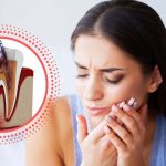 Managing Post-operative Pain After Root Canal Treatment