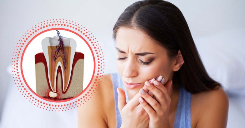 Managing Post-operative Pain After Root Canal Treatment: Best Practices Managing Post-operative Pain After Root Canal Treatment: Best Practices