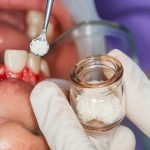 Bone Grafts and Membranes: Everything Dentists Need to Know