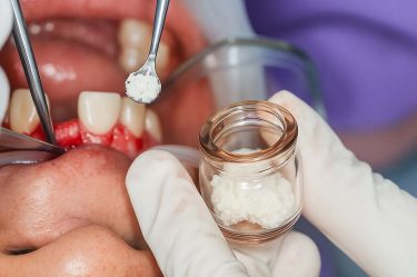 Bone Grafts and Membranes: Everything Dentists Need to Know