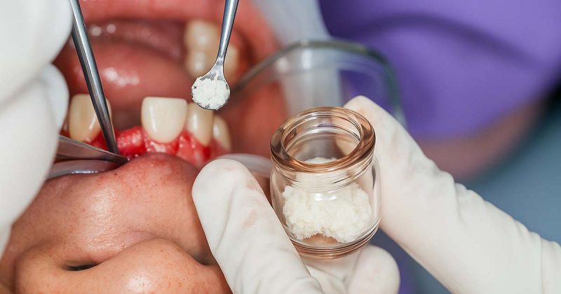 Bone Grafts and Membranes: Everything Dentists Need to Know Bone Grafts and Membranes: Everything Dentists Need to Know
