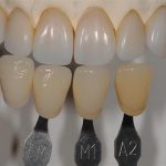 Shade Matching in Dentistry