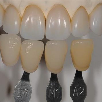 Best Practices for Shade Matching in Dentistry Best Practices for Shade Matching in Dentistry