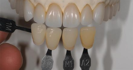 Best Practices for Shade Matching in Dentistry