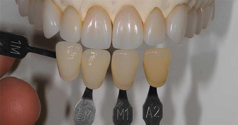 Best Practices for Shade Matching in Dentistry Best Practices for Shade Matching in Dentistry