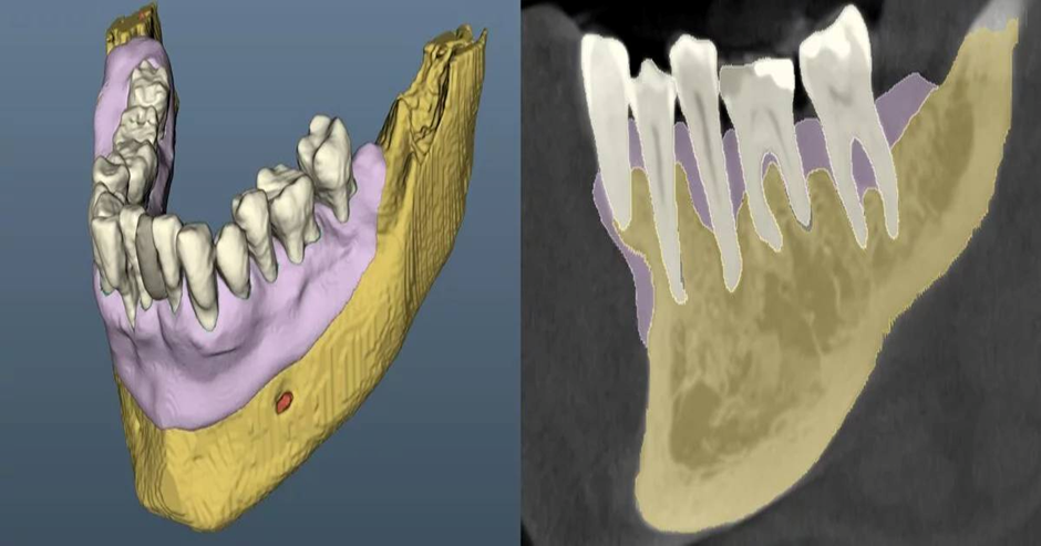3D guided periodontal surgery