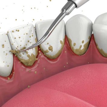 Non-Surgical Periodontal Therapy: A Complete Beginner’s Guide to Gum Disease Treatment 
