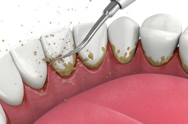 Non-Surgical Periodontal Therapy