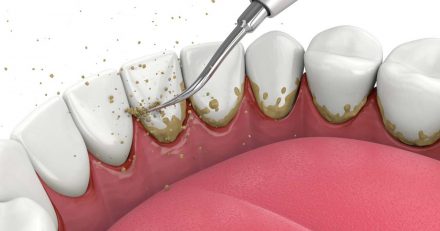 Non-Surgical Periodontal Therapy: A Complete Beginner’s Guide to Gum Disease Treatment 