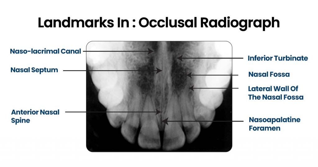 landmarks in Occlusal Radiograph