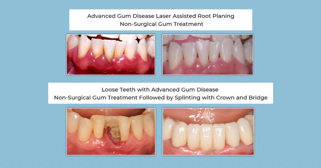 Non-Surgical Periodontal Therapy