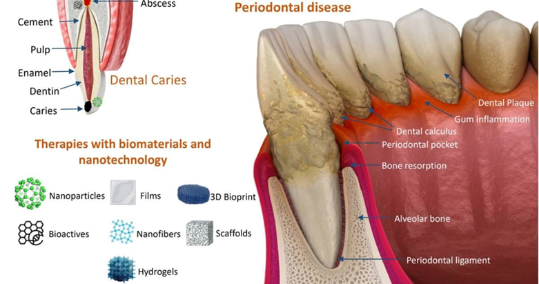 periodontal disease