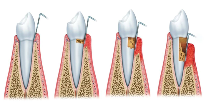 periodontal therapy