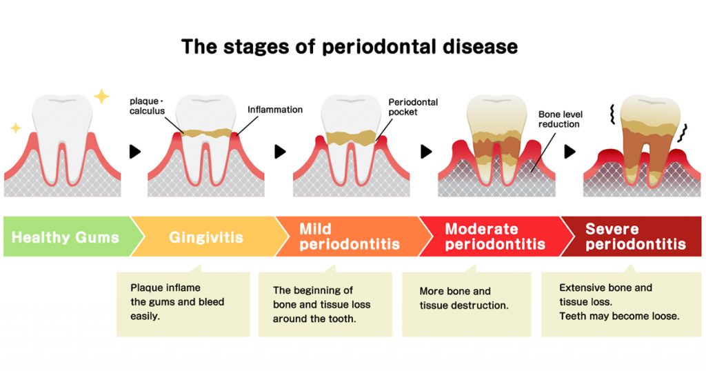 stages of periodontal disease