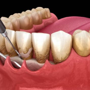 The Ultimate Dentist’s Guide to Surgical Periodontal Therapy  